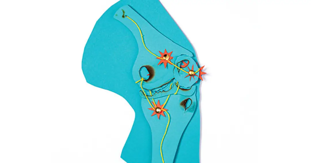 Esses são os melhores exercícios para artrose no joelho, revela estudo