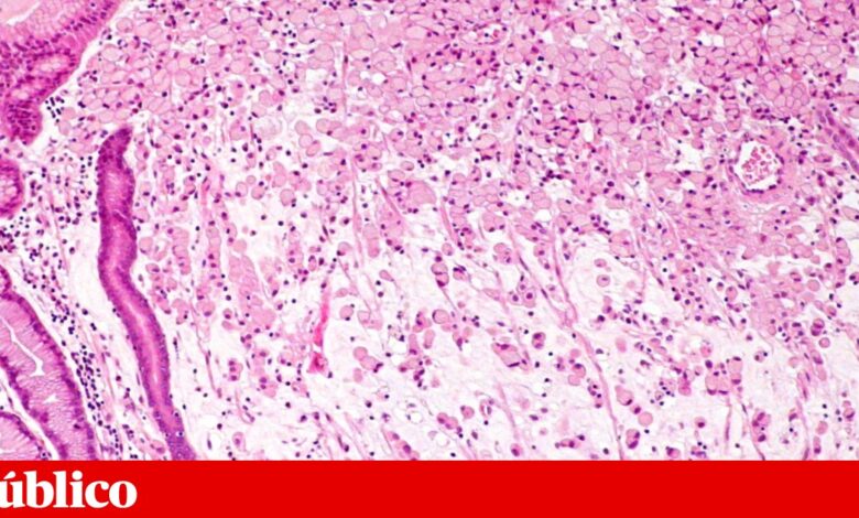 Estudo de gene ligado a dois cancros hereditários conduz aos Critérios do Porto