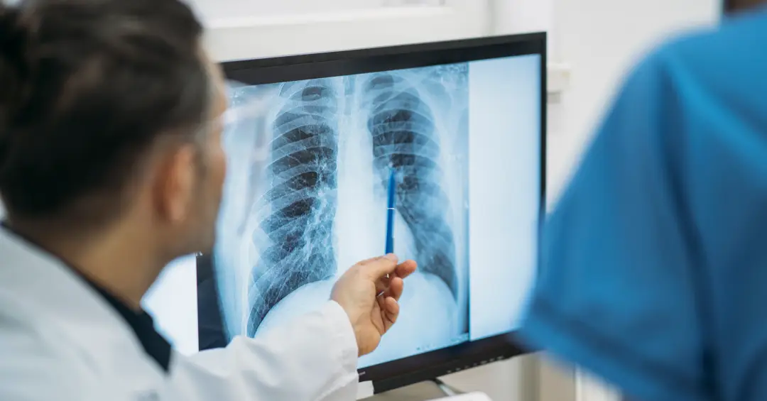 Brasil não alcança meta da OMS para controle da tuberculose