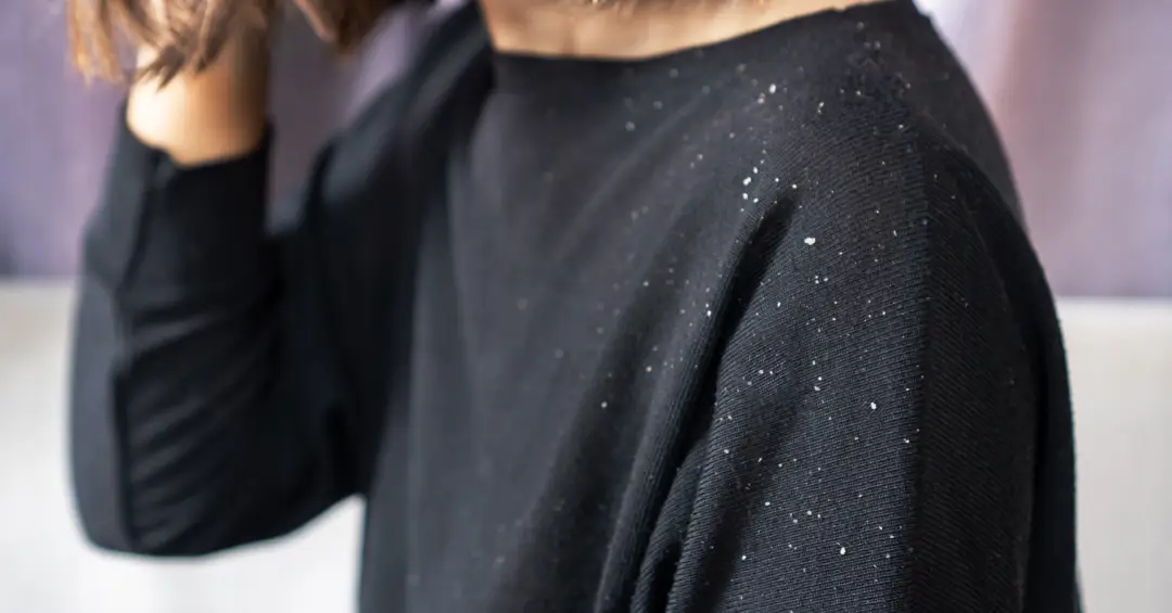 Caspa pode ser diferente em homens e mulheres: o que muda no tratamento?