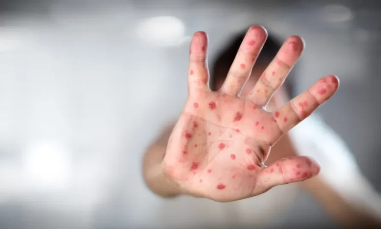 DGS registou "20 casos de sarampo" desde o início do ano em Portugal