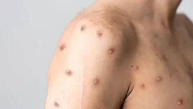 Nova cepa mais perigosa de Mpox é identificada pela segunda vez em São Paulo