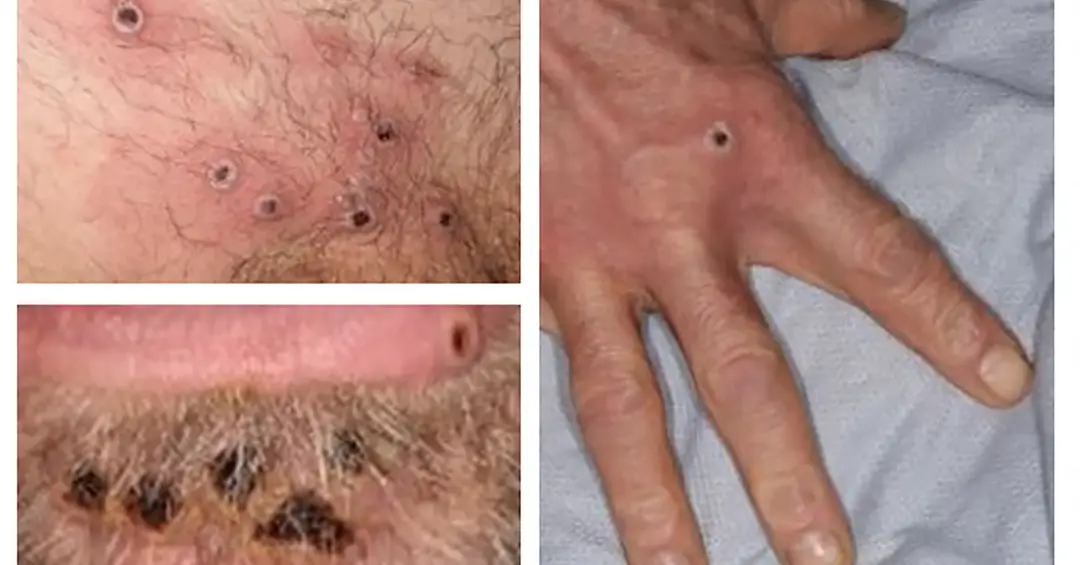 Mpox: como diferenciar as lesões da infecção de outras doenças de pele