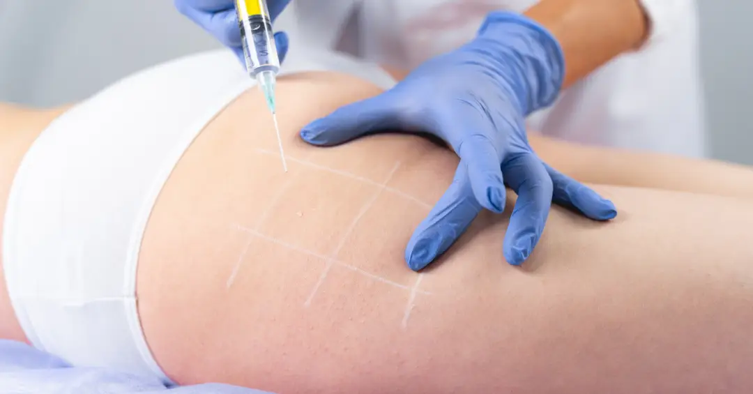 Novo procedimento estético usa gordura de pessoas falecidas como preenchimento