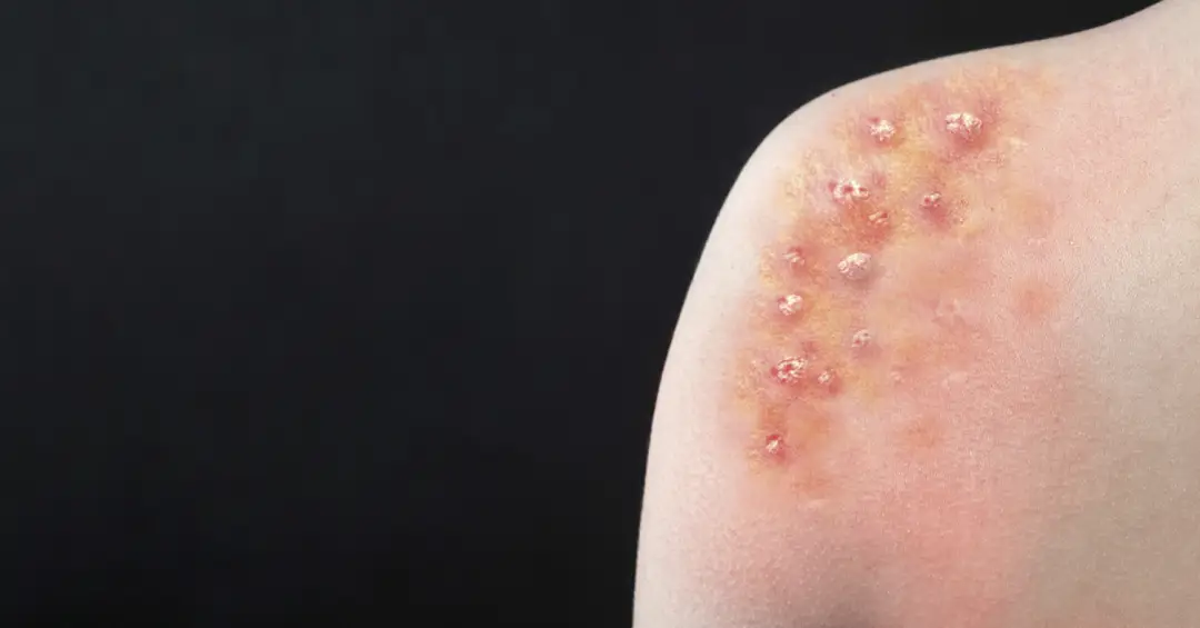 Porto Alegre confirma caso de Mpox e prefeitura faz alerta para Carnaval