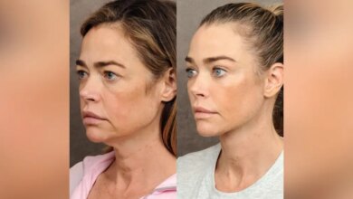 Mudança radical: a evolução impactante do lifting facial
