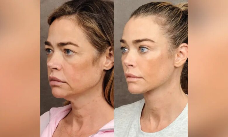 Mudança radical: a evolução impactante do lifting facial
