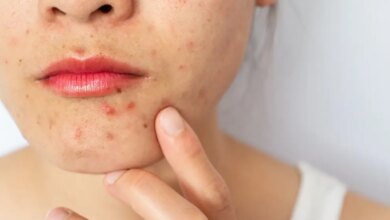 Cravos e espinhas: nova diretriz europeia atualiza tratamento da acne após quase 10 anos