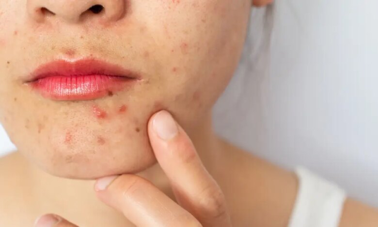 Cravos e espinhas: nova diretriz europeia atualiza tratamento da acne após quase 10 anos