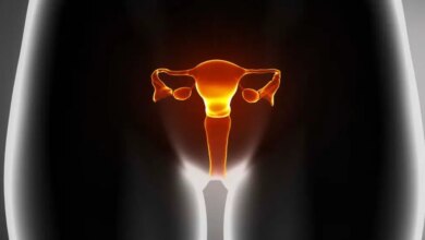 Por que uma doença que afeta mais de 170 milhões de mulheres vai mudar de nome