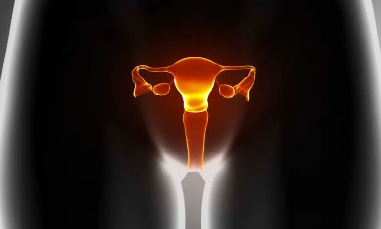 Por que uma doença que afeta mais de 170 milhões de mulheres vai mudar de nome