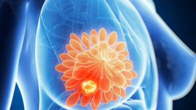 Estudo aponta impactos da dieta, exercícios e vitamina D em pacientes com câncer de mama