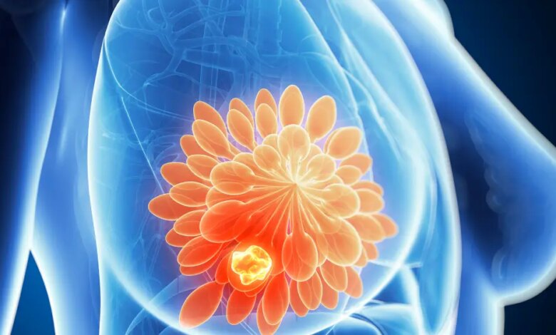 Estudo aponta impactos da dieta, exercícios e vitamina D em pacientes com câncer de mama