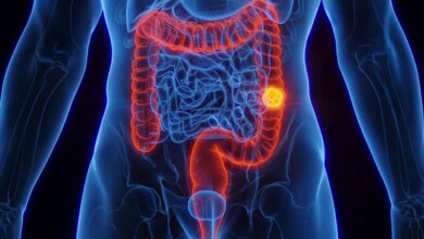 O efeito das canetas emagrecedoras no risco de câncer de intestino