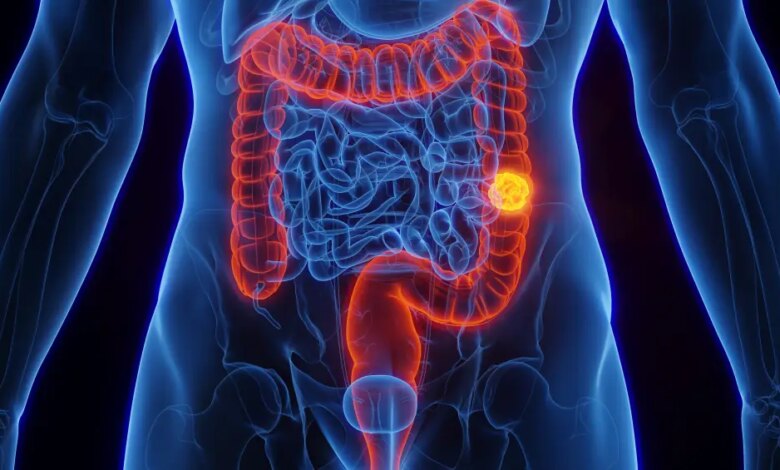 O efeito das canetas emagrecedoras no risco de câncer de intestino