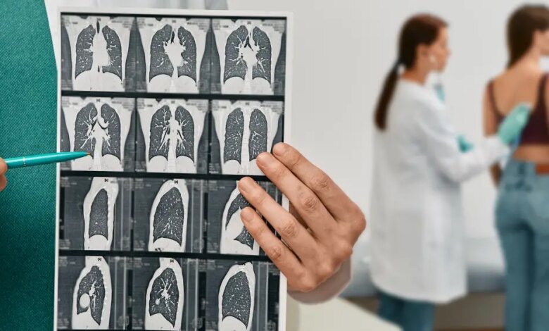 Anvisa aprova tratamento inédito contra doenças que formam cicatrizes nos pulmões