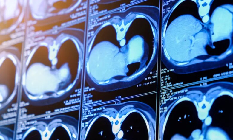 Câncer de rim: Anvisa aprova nova terapia para reduzir risco de retorno da doença em pacientes de alto risco