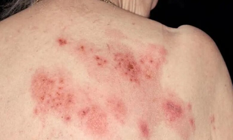 Canetas emagrecedoras e herpes: o alerta que vem de uma nova análise com milhares de usuários