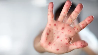 Sarampo avança no estado de São Paulo com sete novos casos confirmados; saiba cidades afetadas