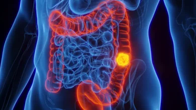 Mudanças nas fezes podem indicar câncer de intestino; saiba os sinais