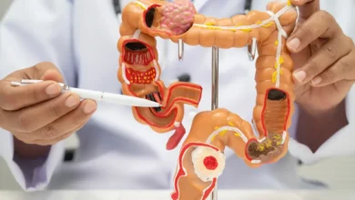 Câncer de intestino, excesso de peso e canetas emagrecedoras: o que a ciência nos mostra até aqui