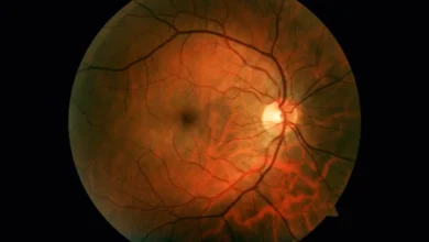 Retinopatia diabética e as cifras invisíveis que rondam a perda de visão