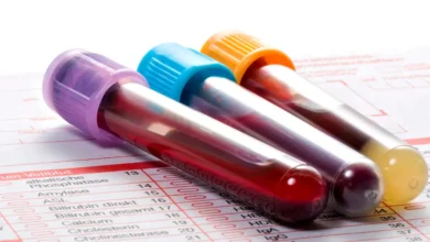Novo exame de sangue para Alzheimer: quem deve fazer?