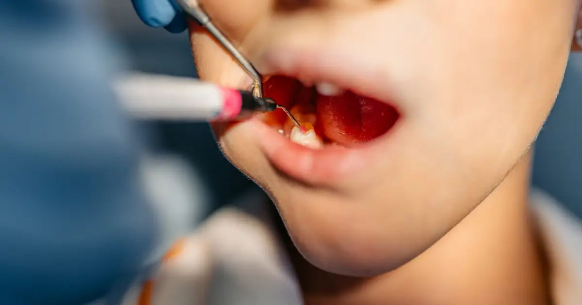 Crianças brasileiras vão ao dentista pela primeira vez só aos 7 anos, aponta levantamento