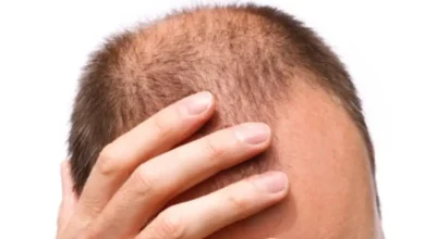 Novo remédio para calvície vem por aí e promete desbancar os clássicos